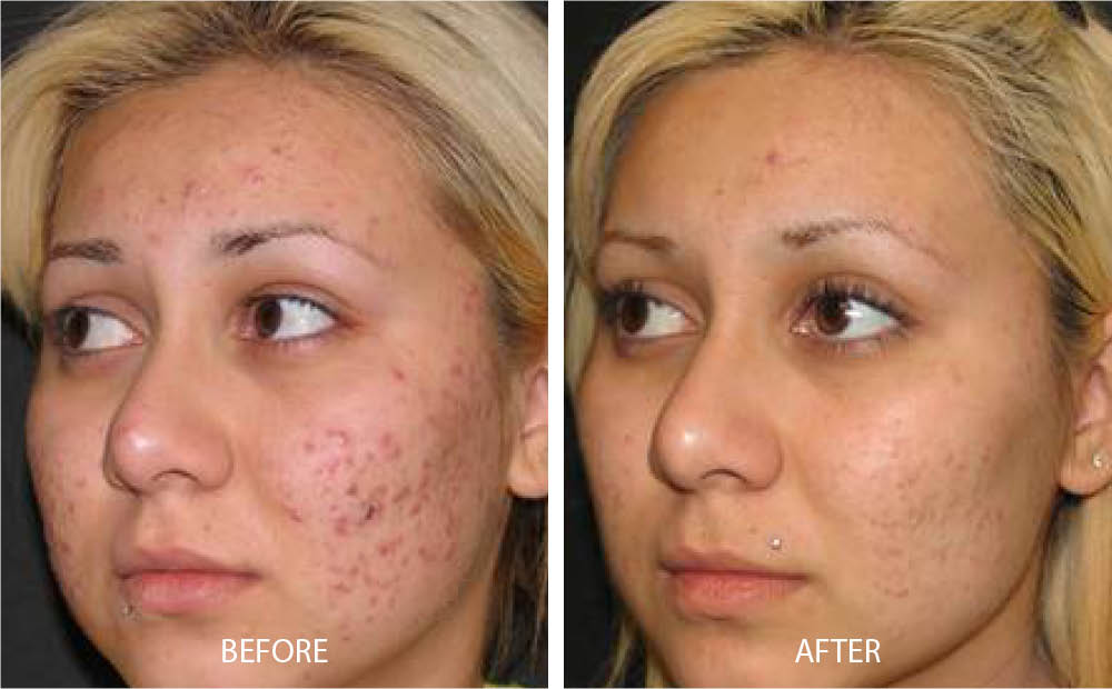 Laser Acne Treatment
