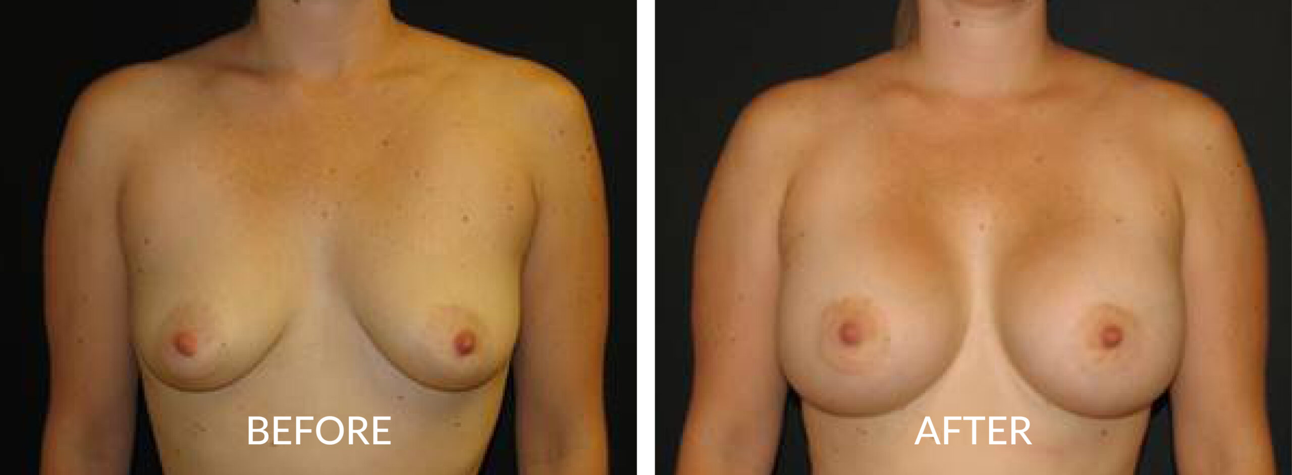 Breast Augmentation