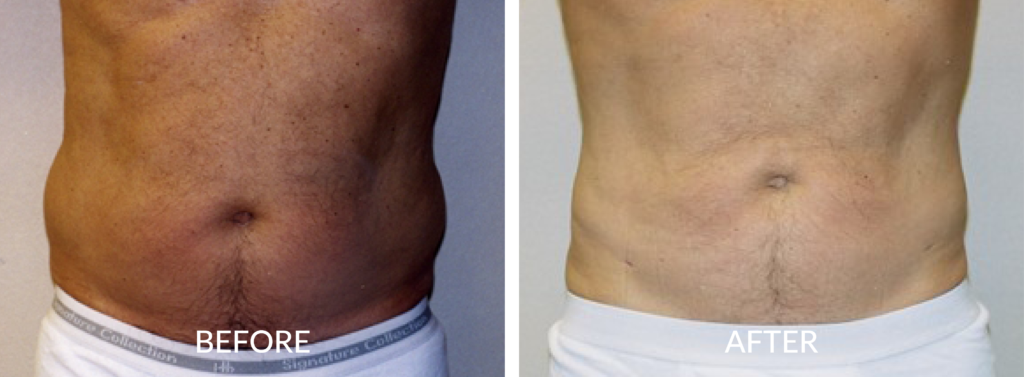 High Definition Liposuction Before And After Photos Dr Ali Heidari 9398