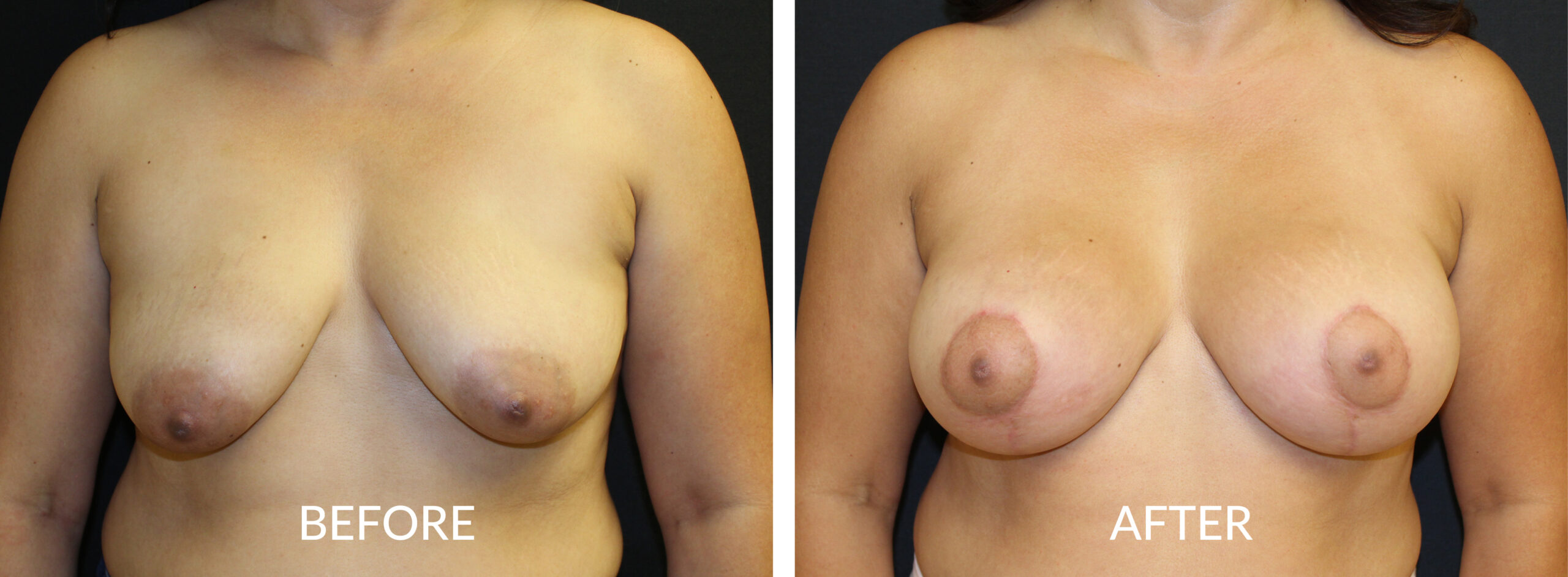 Breast Mastopexy with Impant