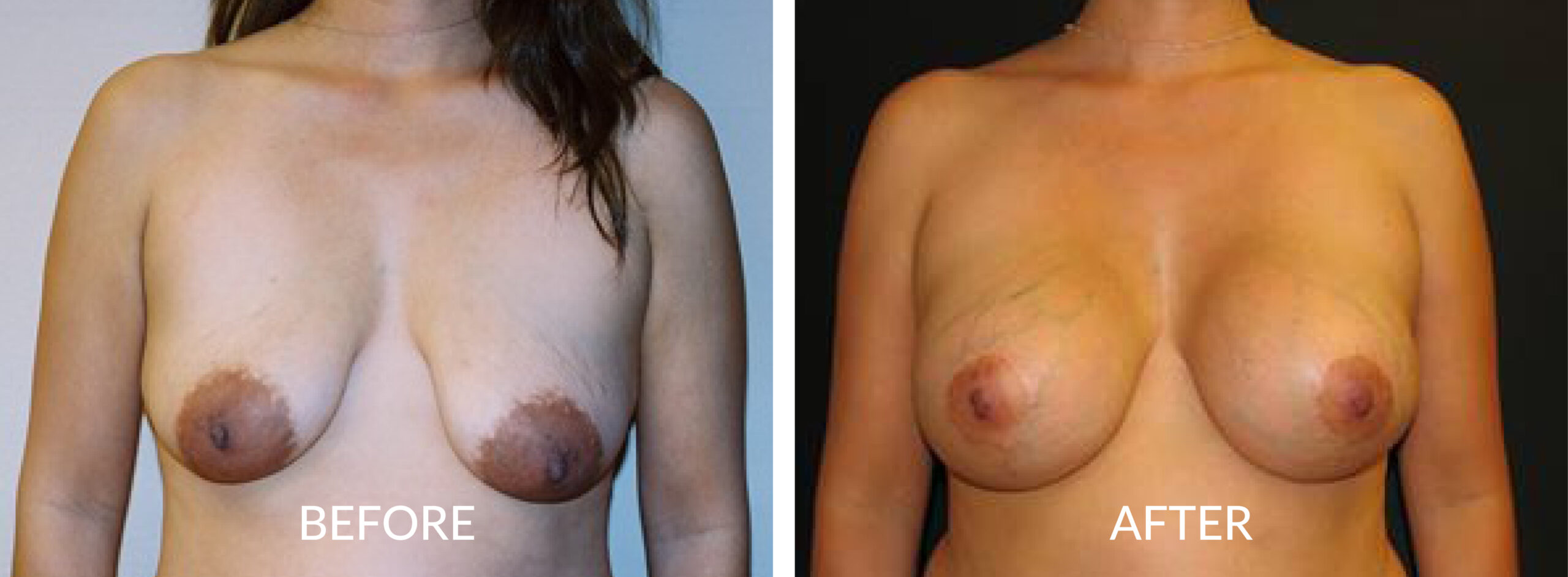 Breast Mastopexy with Impant