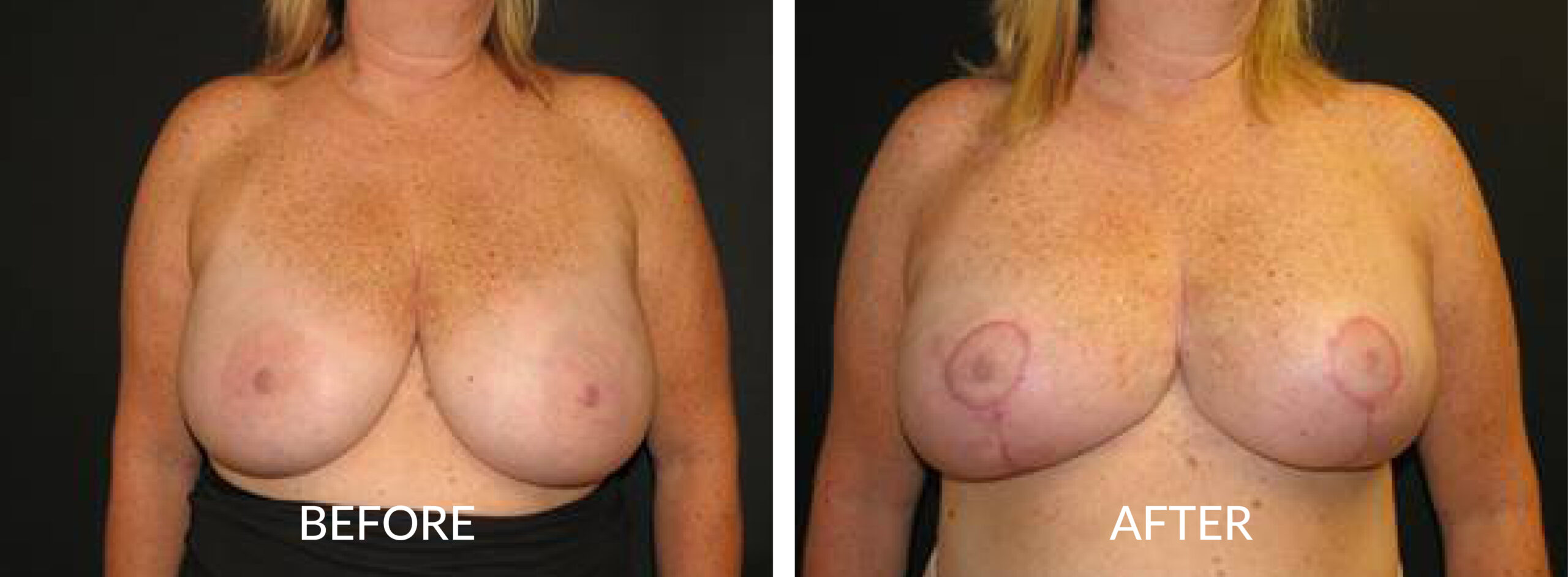 Breast Mastopexy & Reduction