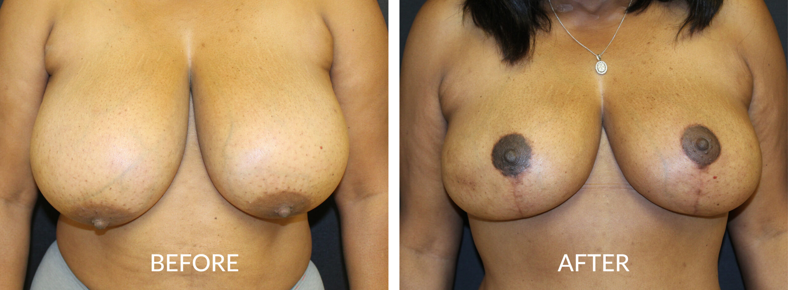 Breast Mastopexy & Reduction