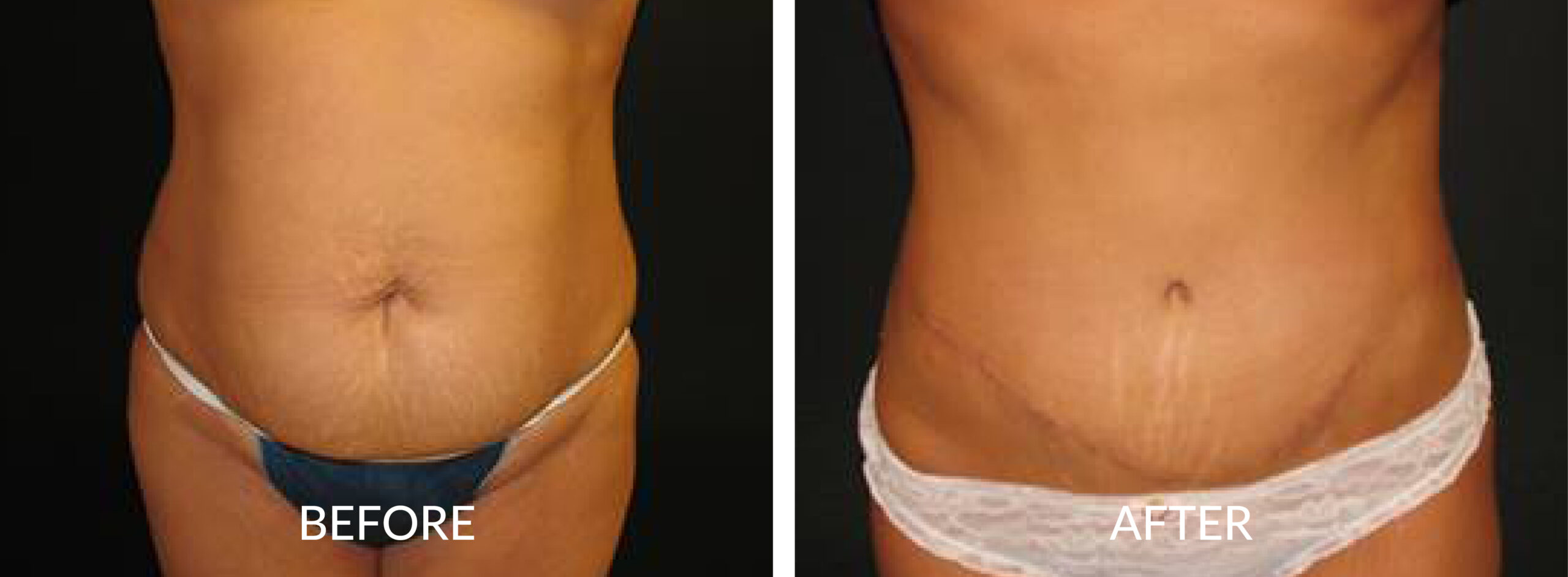 Abdominoplasty
