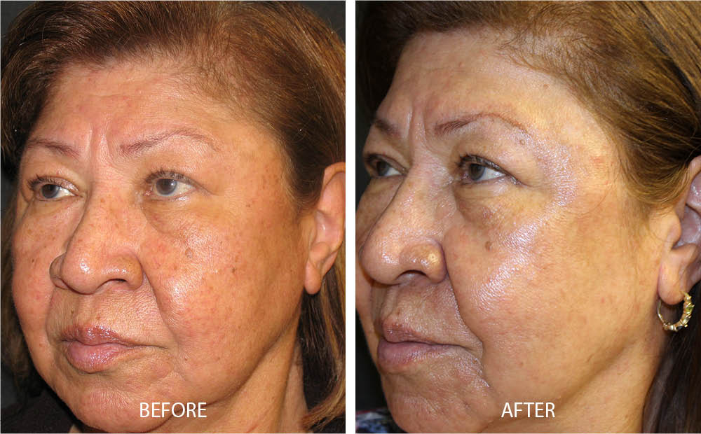 Photo Rejuvenation