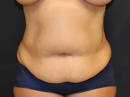 High Definition Liposuction